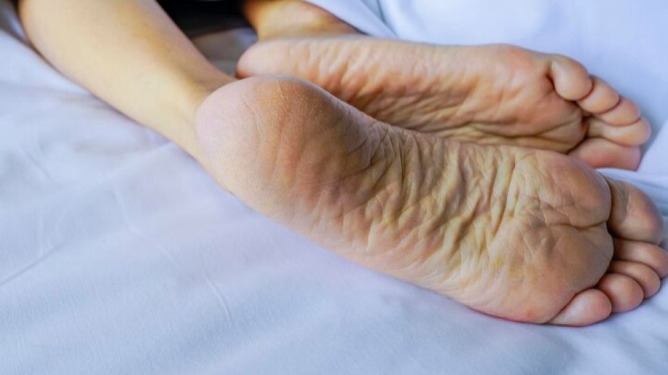 Bahan Alami Yang Ampuh Untuk Mengatasi Kapalan Di Tangan Dan Kaki