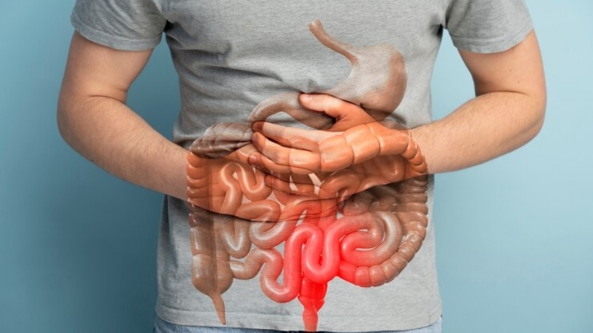 Gejala dan Penyebab Tumor Usus, Penyakit Diderita Mpok Atiek Bisa Gara-gara Keturunan