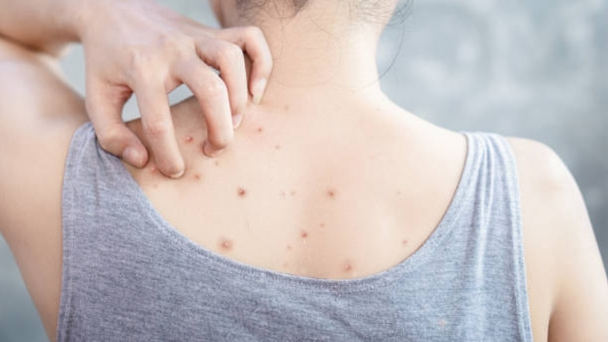 3 Rekomendasi Jerawat Punggung Spray, Praktis dan Cepat Meresap