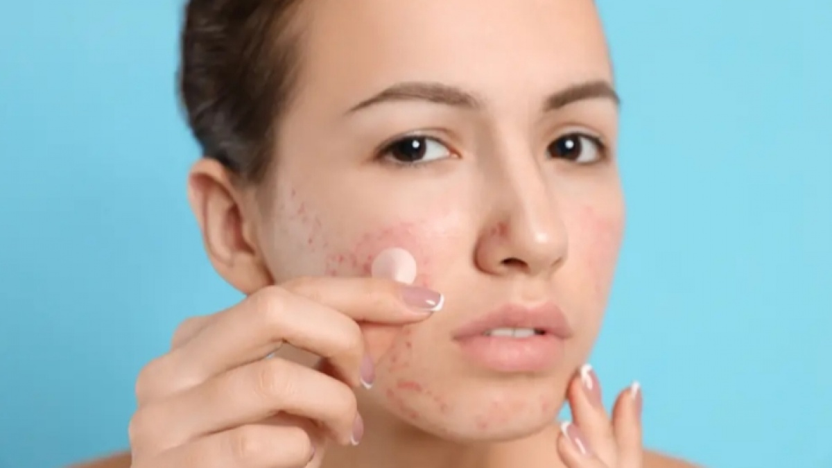 Cara Cerdas Pakai Acne Patch Menurut Dokter, Biar Tak Iritasi dan Over Eksfoliasi