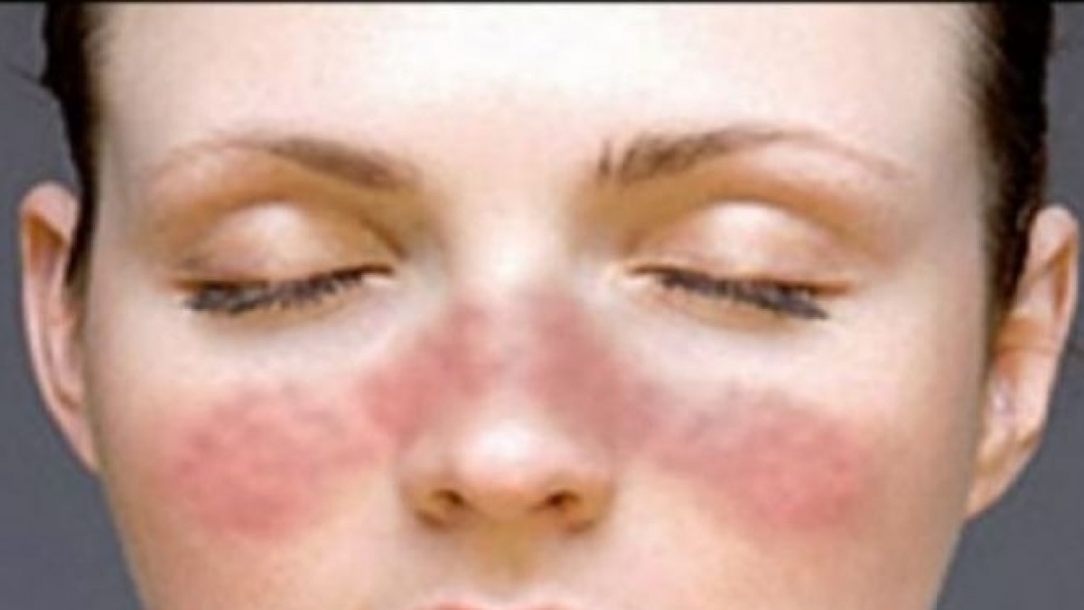 Mengapa Lupus Lebih Banyak Menyerang Wanita?