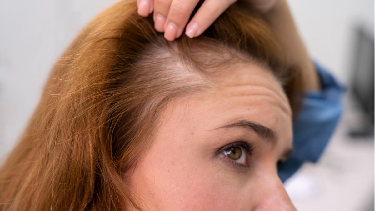Banyak Ibu Mengalaminya, Ini Kisah Bangkit dari Kerontokan Rambut Pascapersalinan