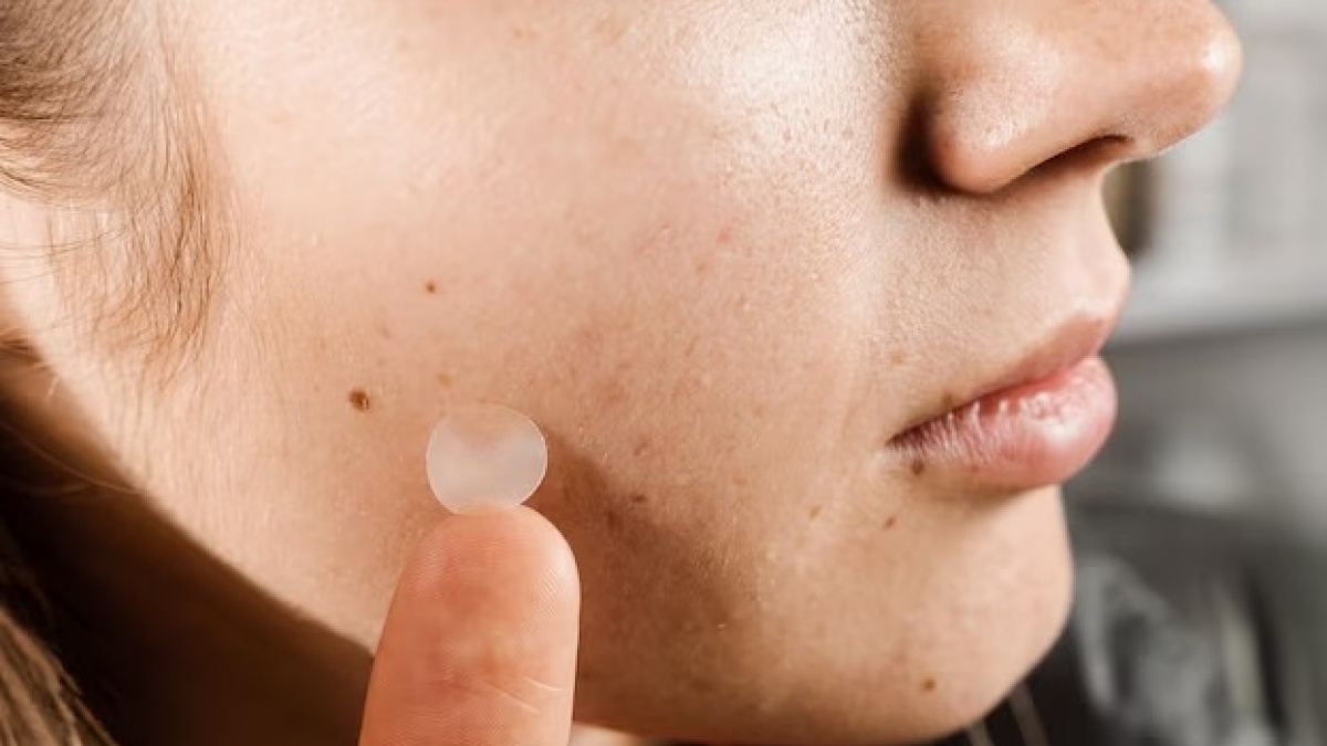 6 Acne Patch yang Ampuh Atasi Jerawat Bernanah, Sekali Pakai Langsung Pecah