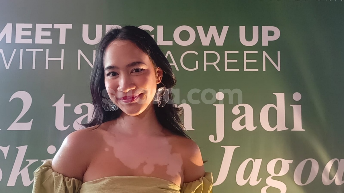 Percaya Diri dengan Vitiligo, Salma Kyana Ungkap Makna Kecantikan