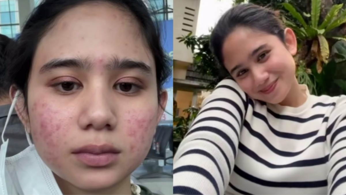 Tissa Biani Alami Wajah Breakout 4 Tahun, Dokter Kulit Akui Dampaknya Buat Mental