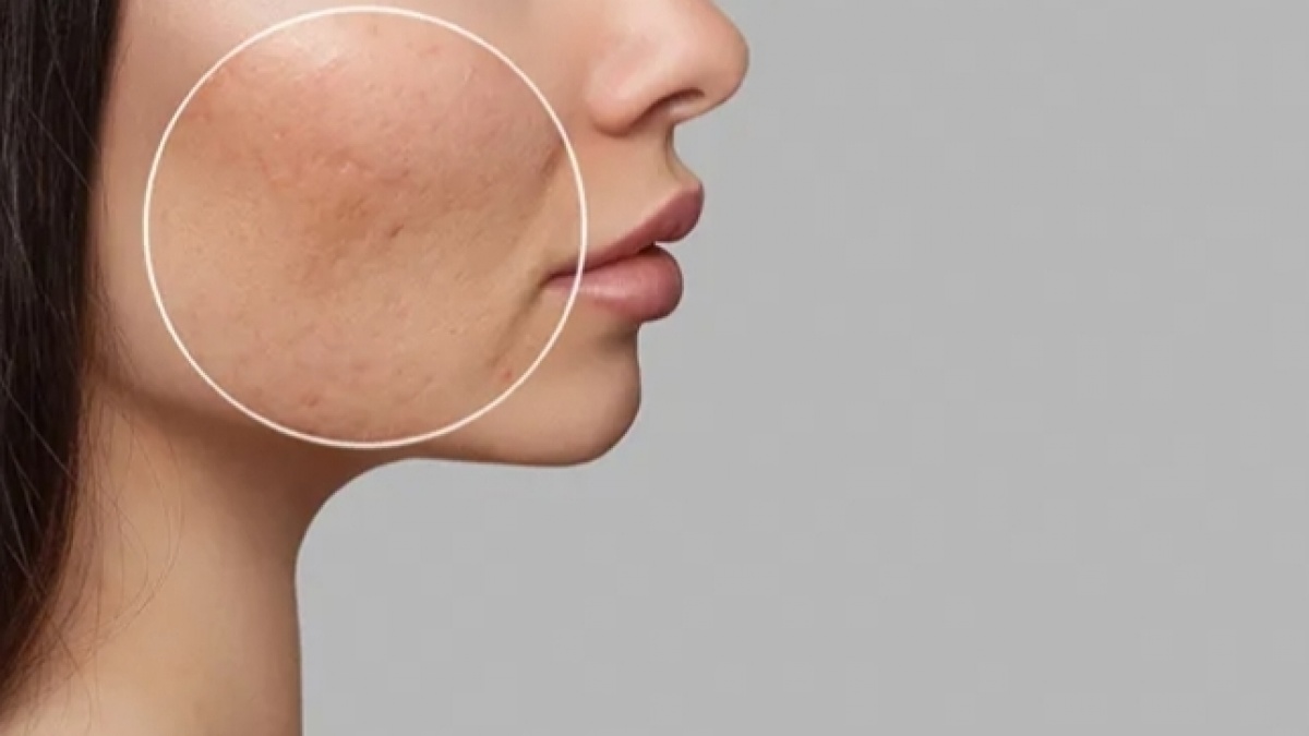 Apakah Bopeng Bisa Dihilangkan dengan Skincare?