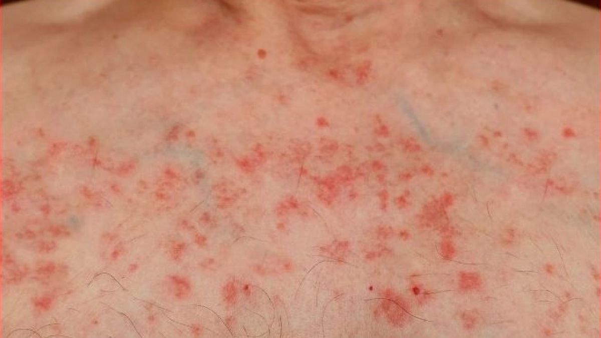 Pertanda di Kulit yang Mesti Diwaspadai Penyebab Leukimia, Diantaranya Kurap