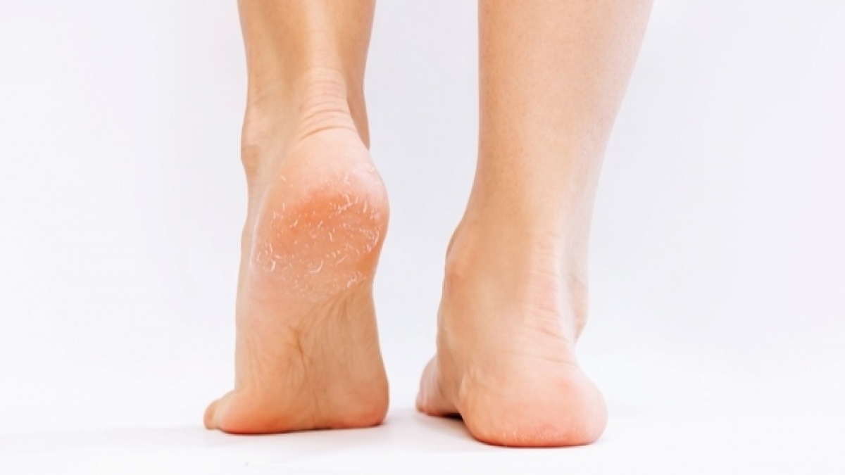 10 Rekomendasi Krim Kaki Terbaik (Foot Cream) untuk Kulit Kering dan Kapalan