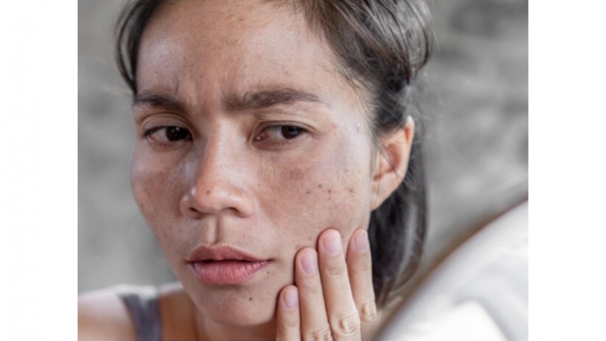 5 Krim Penghilang Flek Hitam Terbaik di Apotek, Aman untuk Kulit Sensitif
