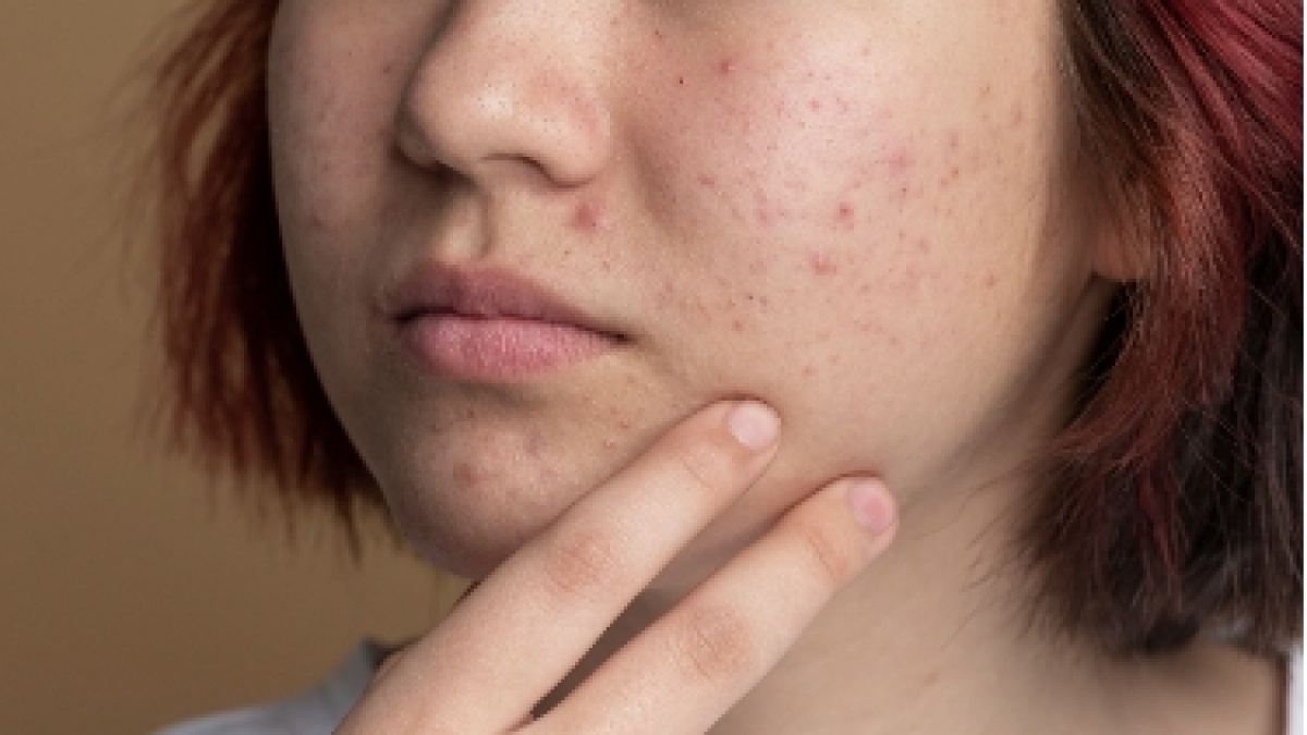 10 Rekomendasi Moisturizer dengan Salicylic Acid, Jerawat Lewat, Wajah Glowing Maksimal