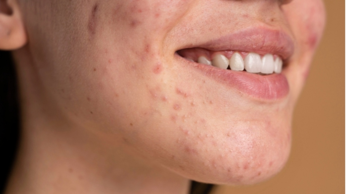 5 Moisturizer untuk Kulit Bruntusan Mulai Rp30 Ribuan, Bisa Meredakan Kemerahan