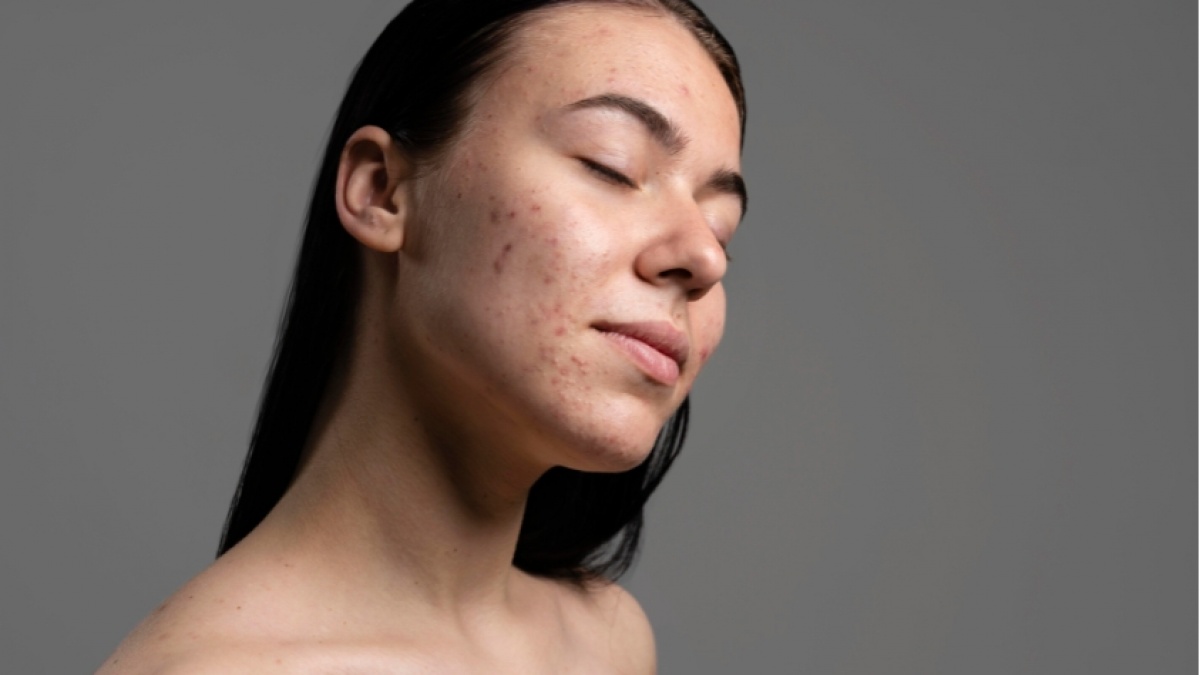 Bye-Bye Bekas Jerawat! 5 Skincare Ampuh Bikin Kulit Mulus Lagi