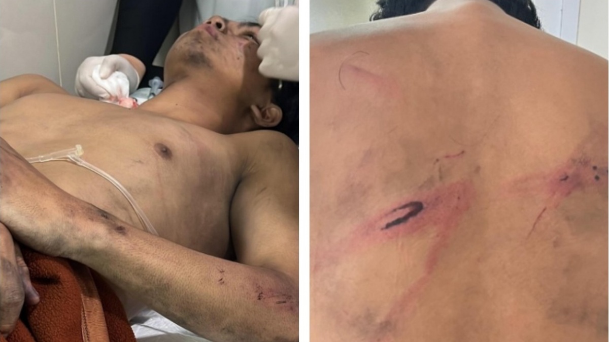 Pulang Rayakan Ultah, Pemuda di Bandung salah Sasaran Polisi hingga Alami Luka Parah
