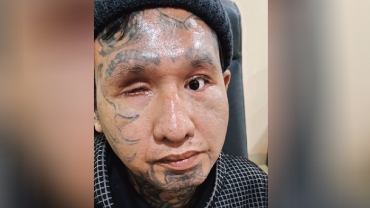 Icang, Korban Congkel Mata di Bogor Meninggal Dunia