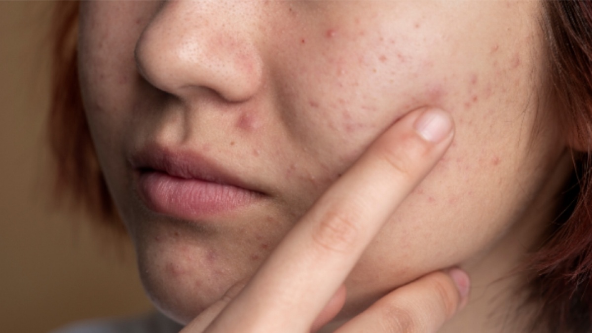 5 Sabun Muka Salicylic Acid untuk Sembuhkan Jerawat, Bantu Menenangkan Kulit