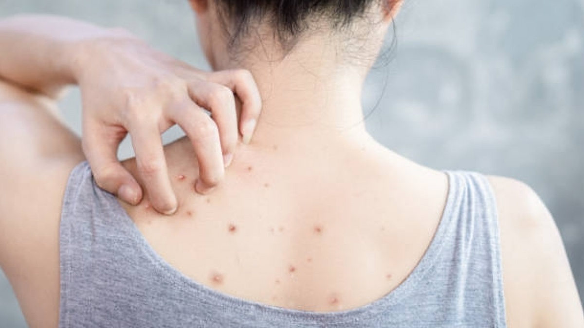 5 Rekomendasi Body Spray untuk Atasi Jerawat Punggung, Mulai dari Rp 70 Ribuan
