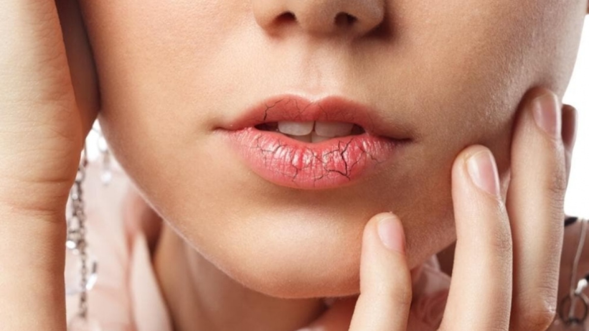 Bibir Kering dan Pecah? Waspada, Tubuh Sedang Kekurangan Salah Satu dari 7 Vitamin Ini