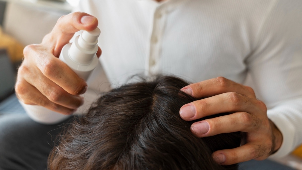 5 Hair Tonic untuk Atasi Ketombe dan Gatal, Kulit Kepala Jadi Lebih Sehat