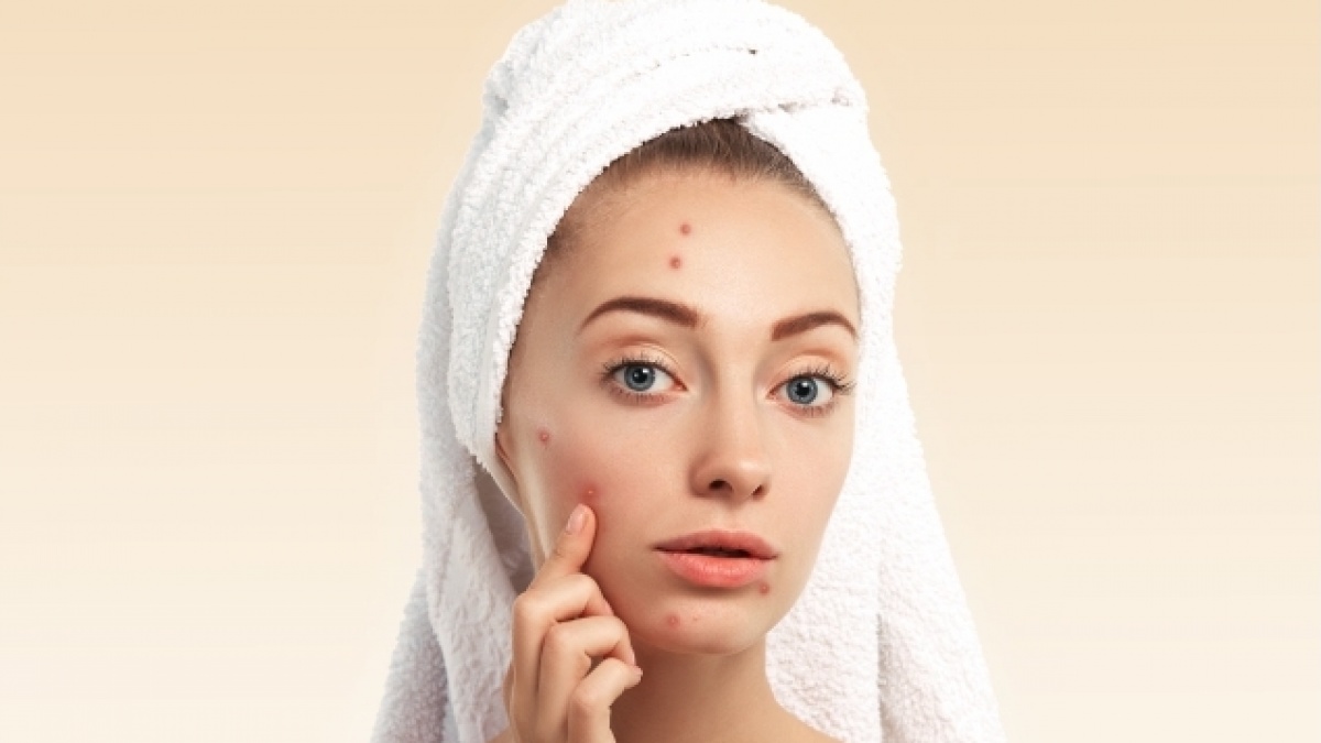 Jerawat Makin Parah Setelah Pakai Skincare Baru? Ini Perbedaan Breakout dan Purging