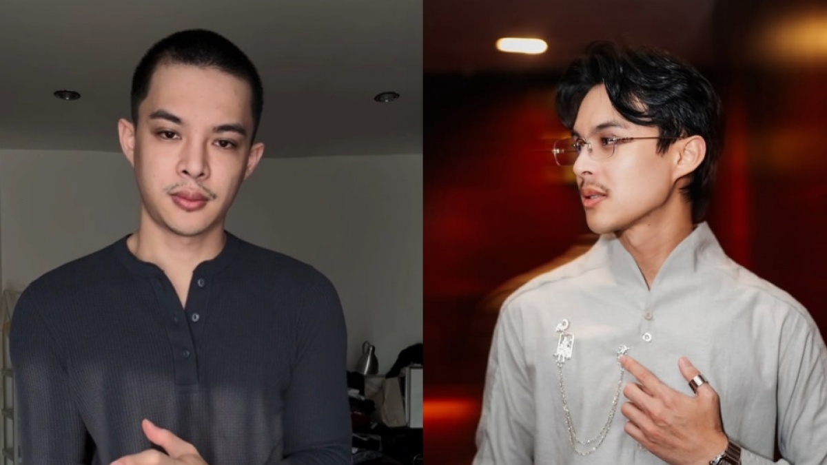 Rey Mbayang Idap Autoimun Psoriasis, Alami Kerontokan Rambut Parah