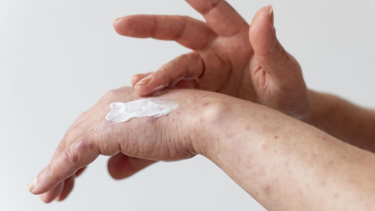 Kenapa Muncul Bercak Hitam di Tangan? Ini Penyebab dan 5 Sunscreen Ampuh Mengatasinya