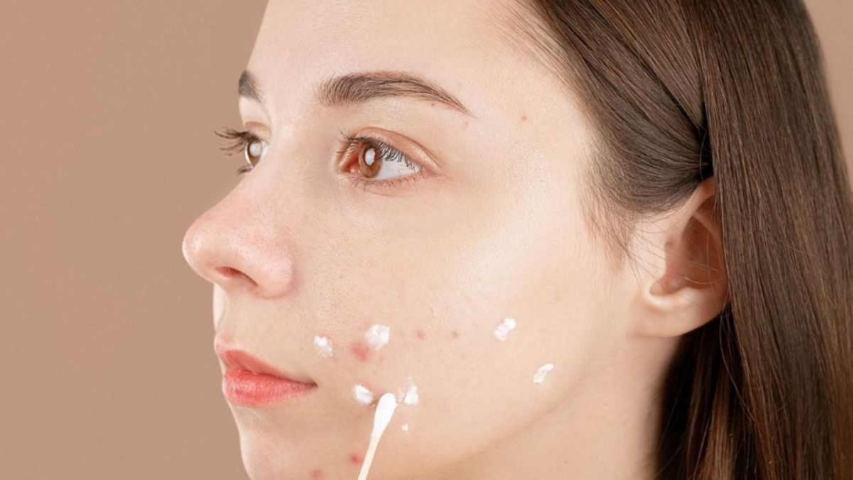 Pakai Obat Totol Jerawat Sebelum atau Sesudah Moisturizer? Ini Urutan yang Tepat