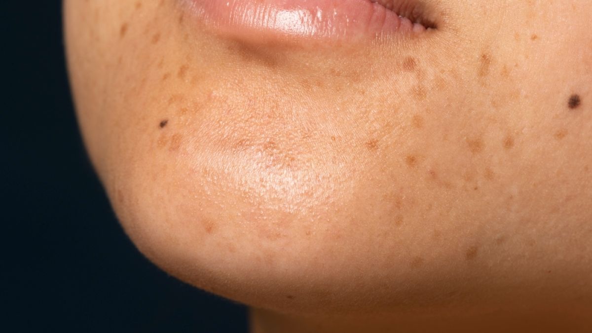 Perbedaan Melasma, Lentigo, dan Hiperpigmentasi Bekas Jerawat pada Kulit: Kenali Ciri-cirinya
