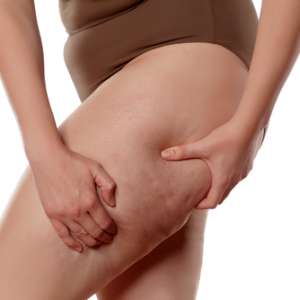Terlalu Kasar Saat Pakai Handuk Stretch Mark Bisa Semakin Parah