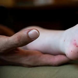 Flu Singapura Merebak di Sumsel, Mengapa Palembang Jadi Daerah dengan Kasus Terbanyak?