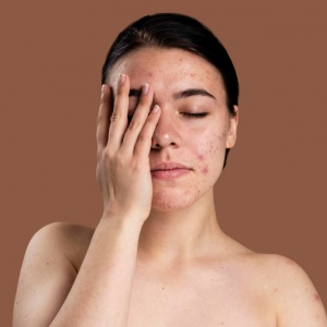 5 Moisturizer untuk Ibu Hamil Saat Berjerawat, Harga Mulai Rp40 Ribuan