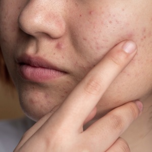 Perbedaan Chemical, Physical, dan Hybrid Sunscreen: Mana yang Paling Cocok untuk Jerawat?