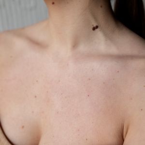 Bagaimana Cara Menghilangkan Flek Hitam di Leher dan Dada Akibat Paparan Matahari?
