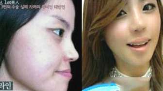 Jadi Cantik Setelah Operasi Plastik, Seorang Perempuan Batal Dicerai Suami