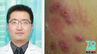 Ini Dia Lelaki yang Miliki Belatung dalam Tubuhnya