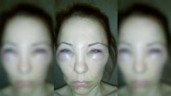 Ingin Cantik Lewat Botox, Wajah Perempuan Ini Malah Bengkak Karena Suntik Bisa Ular
