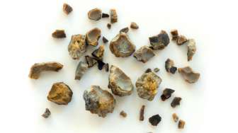 Waspadai Gejala Batu Ginjal, Penyakit yang Diidap Dorce Gamalama Sebelum Diserang Covid-19