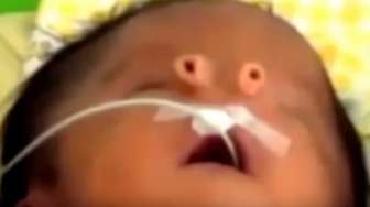 Malaikat Kecil, Nama Buat Bayi yang Lahir dengan Hidung Unik Ini