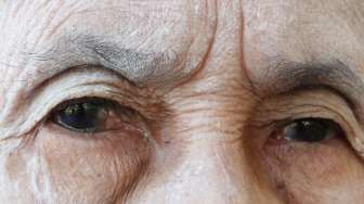 Bisa Sebabkan Kebutaan, Kenali Gejala dan Faktor Risiko Penyakit Mata Wet-AMD