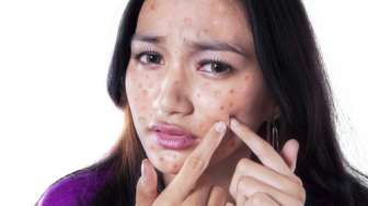 77 Persen Remaja Indonesia Alami Acne Shaming, Bagaimana Bentuknya?