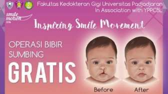 FKG Unpad Gelar Operasi Bibir Sumbing Gratis