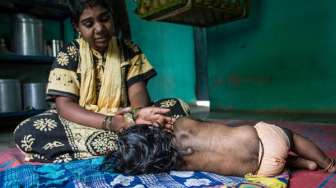 Tumbuh Rambut di Sekujur Tubuh, Bayi Ini Disebut Manusia Serigala