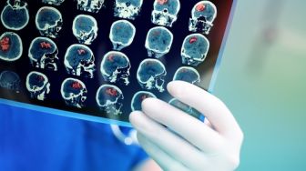 Cegah Tumor Otak, Yuk Perhatikan 3 Pola Hidup Penting Berikut Ini