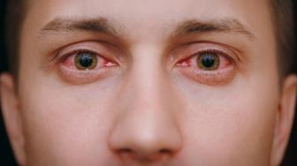 Hati-hati! Penyakit Mata Merah Akibat Virus Sedang Marak di Banyuwangi, Cepat Sekali Menular