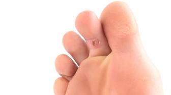 Sering Pakai Sepatu Kebesaran Bisa Bikin Mata Ikan Lho!
