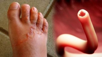 Sering Bermain Tanpa Memakai Sendal, Kaki Bocah ini Berubah Jadi Mengerikan