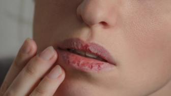 Jangan Cuma Pakai Lipstick, Ini Cara Atasi Bibir Pecah-pecah