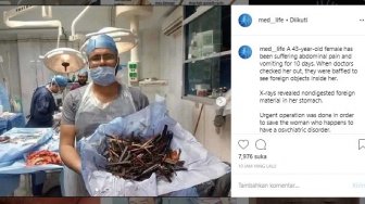 Alami Sakit Perut, Dokter Temukan Pensil Hingga Sendok di Perut Wanita Ini