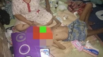 Diasuh Pengamen Ondel-ondel, Bocah 13 Tahun Meninggal karena Gizi Buruk