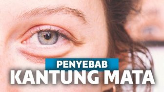 Kantung Mata Susah Hilang? Kenali Penyebab dan Penanganannya