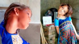 Ngeri! Alami Kelainan Otot, Leher Gadis Ini Bisa Bengkok Sampai 90 Derajat
